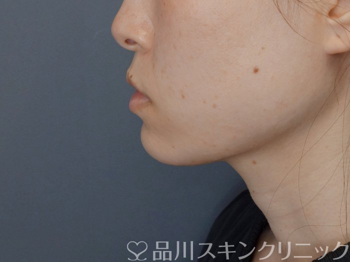 症例NO.72329のAFTER写真