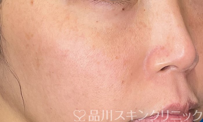 症例NO.72794のAFTER写真