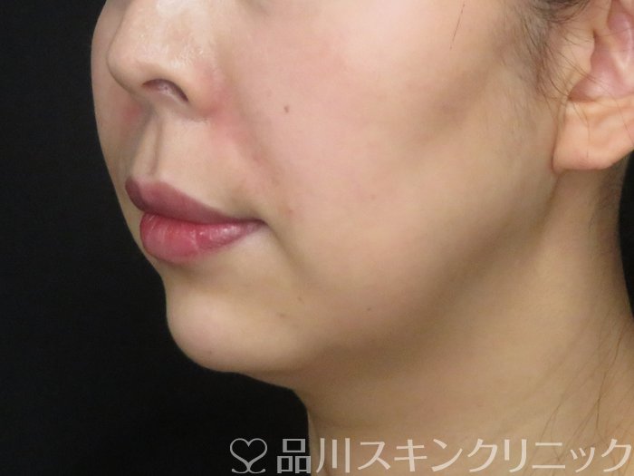 症例NO.69827のAFTER写真