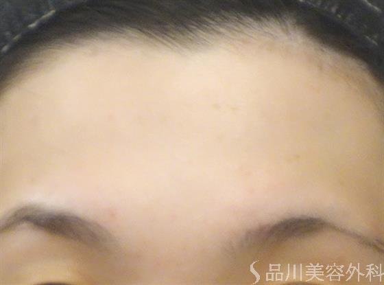 症例NO.25257のAFTER写真