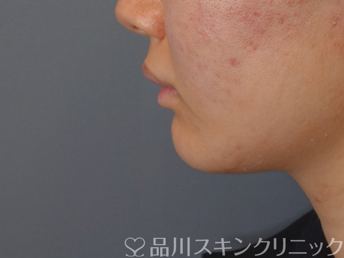 症例NO.72723のAFTER写真