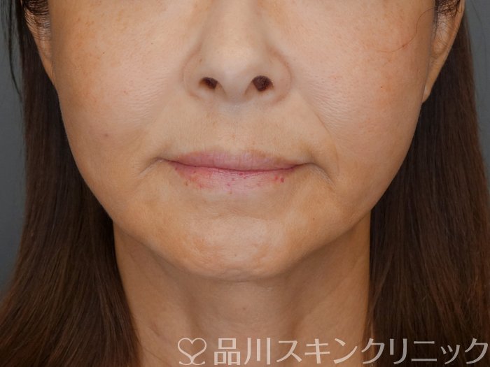 症例NO.71787のAFTER写真