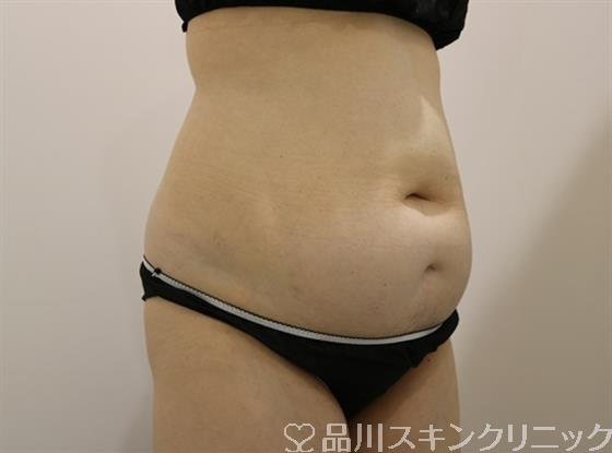 症例NO.44319のBEFORE写真