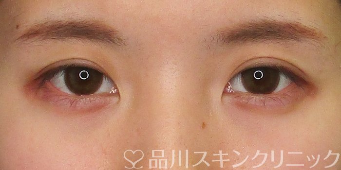 症例NO.70158のAFTER写真