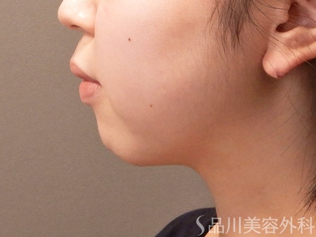 症例NO.70992のBEFORE写真
