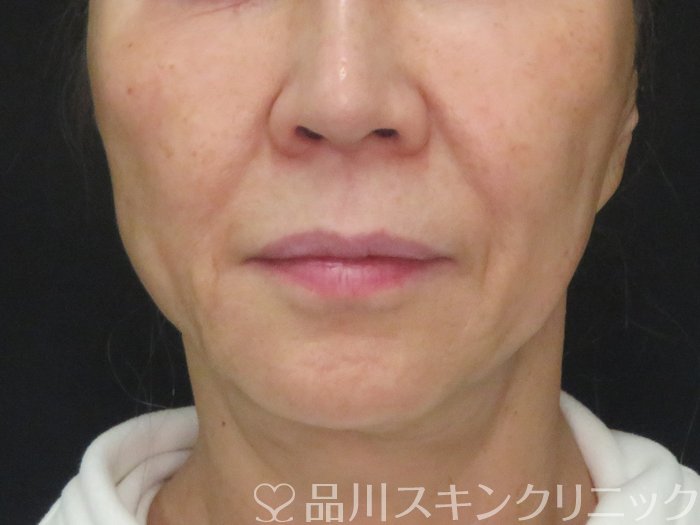 症例NO.73162のBEFORE写真