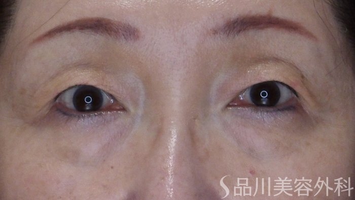 症例NO.71494のBEFORE写真