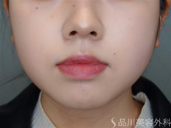 症例NO.51001のBEFORE写真