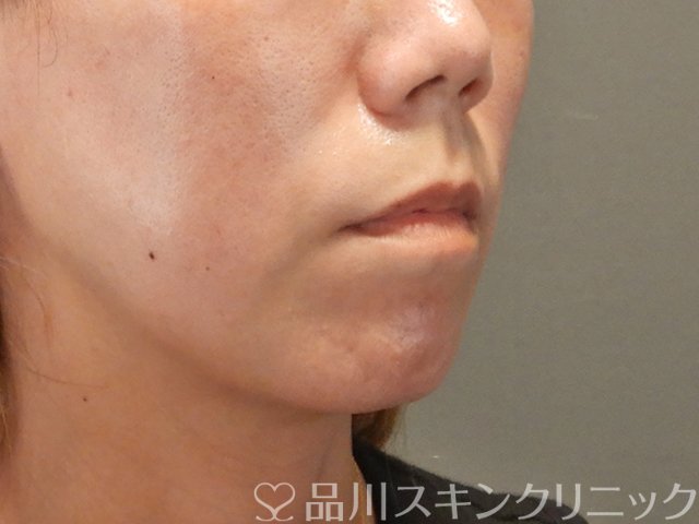 症例NO.75039のBEFORE写真