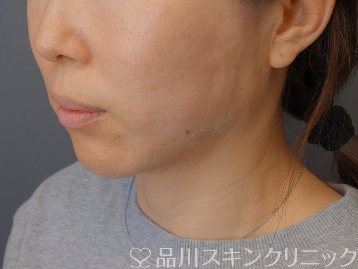 症例NO.72736のAFTER写真