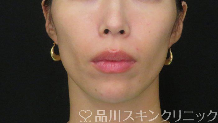 症例NO.72232のAFTER写真