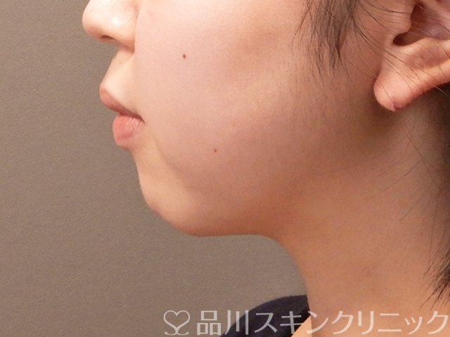 症例NO.70992のBEFORE写真