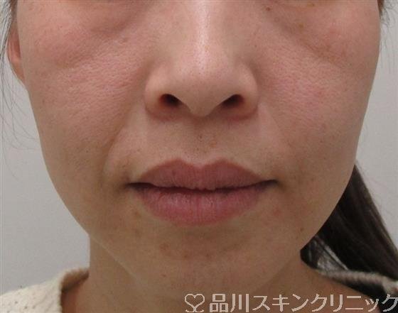 症例NO.53322のBEFORE写真