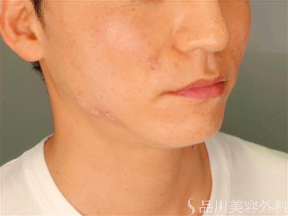 症例NO.55347のAFTER写真