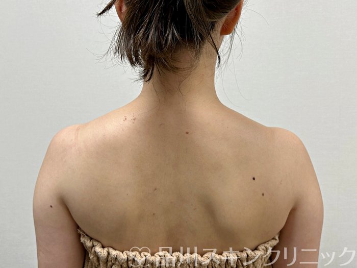 症例NO.74883のBEFORE写真