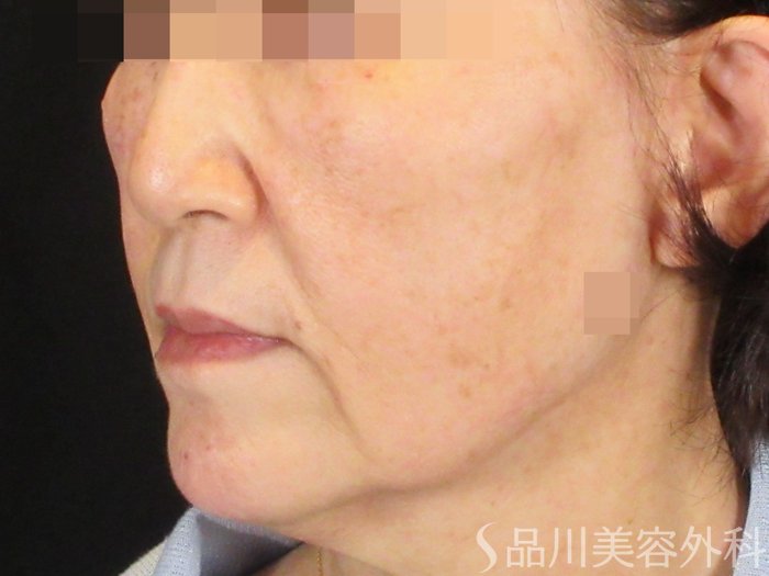 症例NO.75371のBEFORE写真