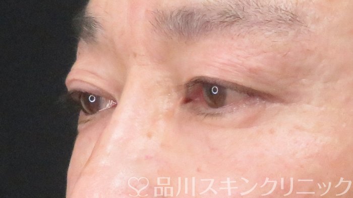 症例NO.69714のAFTER写真