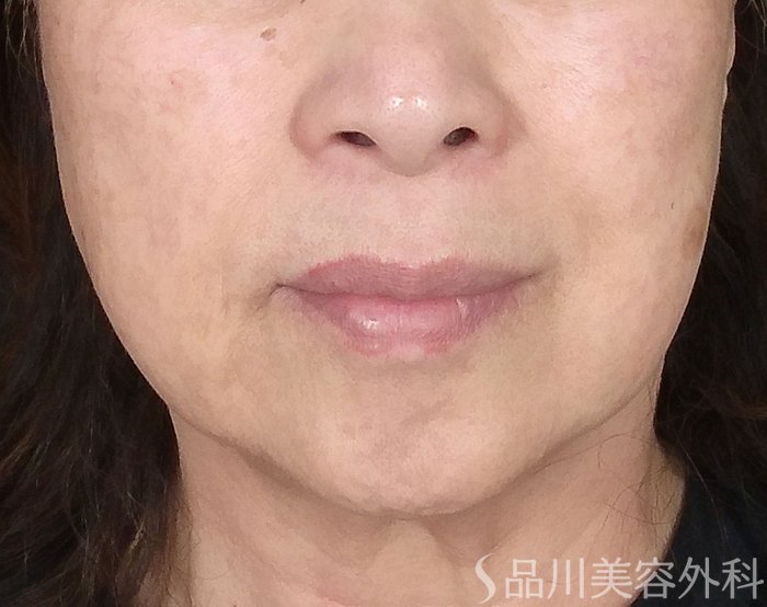 症例NO.65436のBEFORE写真
