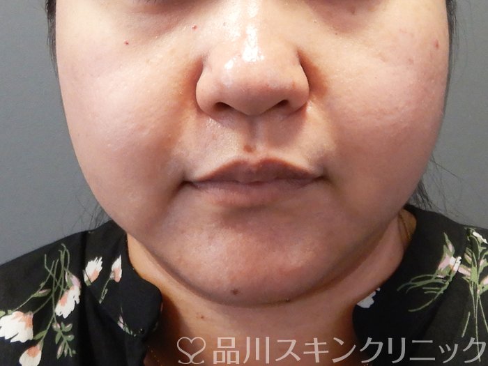 症例NO.69644のAFTER写真