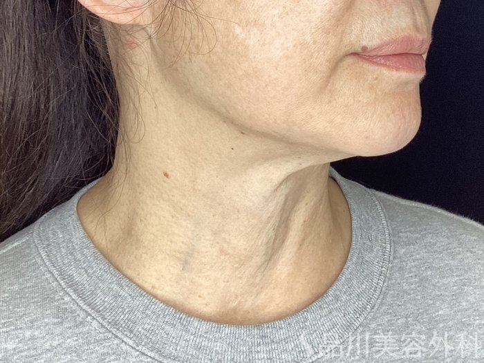 症例NO.69582のBEFORE写真