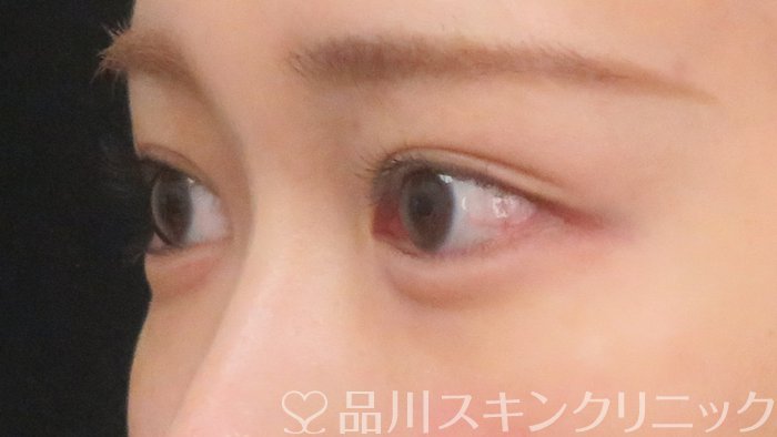 症例NO.69942のAFTER写真