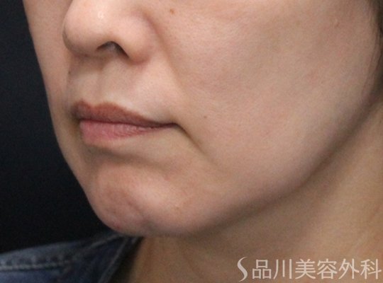 症例NO.75257のBEFORE写真
