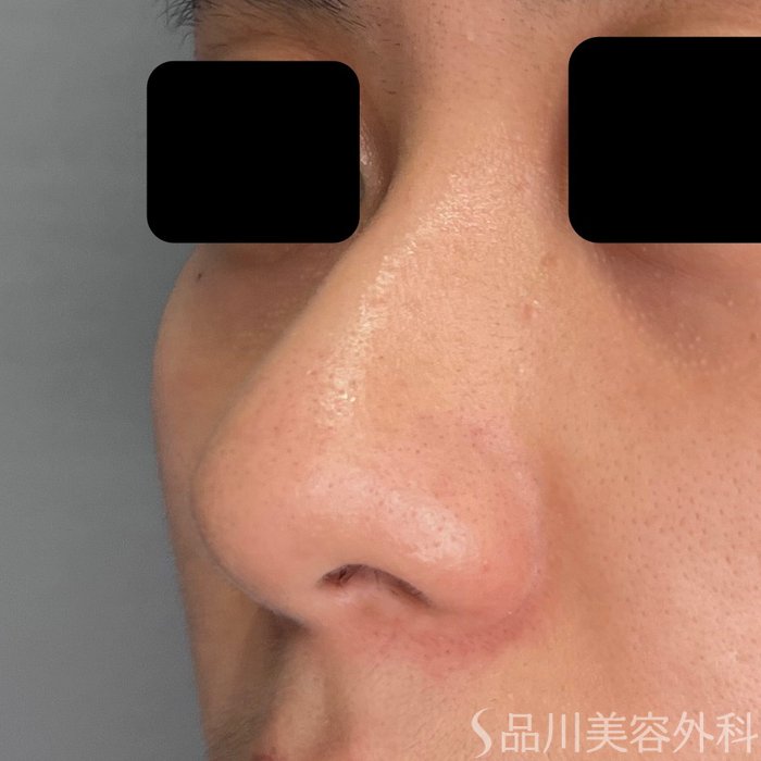 症例NO.72340のBEFORE写真