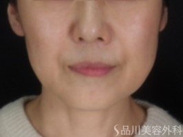 症例NO.73524のBEFORE写真