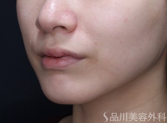 症例NO.73371のAFTER写真