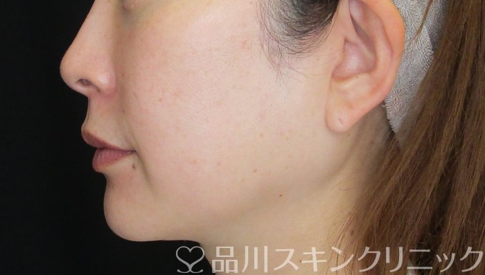 症例NO.74265のBEFORE写真