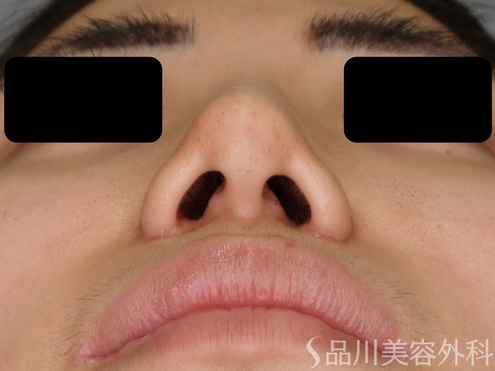 症例NO.70116のAFTER写真