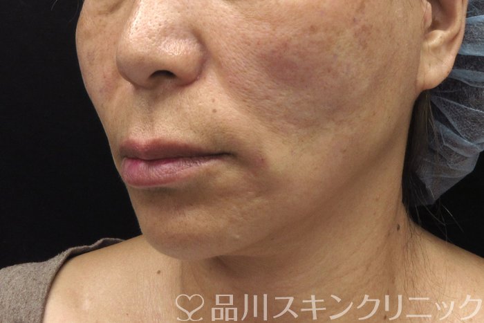 症例NO.74606のAFTER写真