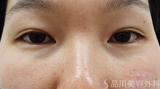 症例NO.36176のBEFORE写真