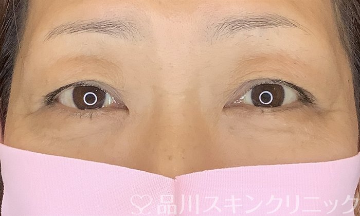 症例NO.70375のBEFORE写真