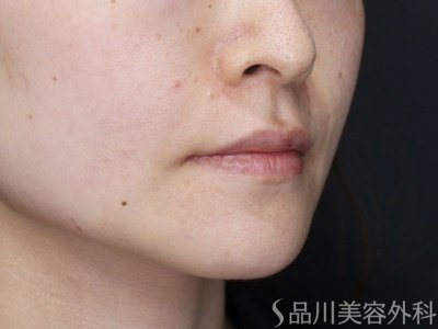 症例NO.70586のAFTER写真