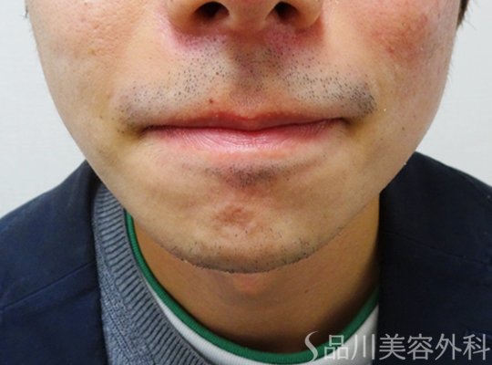 症例NO.71141のBEFORE写真
