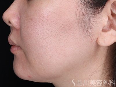 症例NO.67649のBEFORE写真