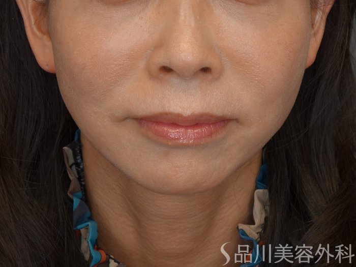 症例NO.74710のAFTER写真