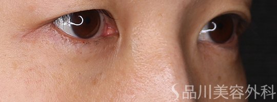 症例NO.71911のAFTER写真