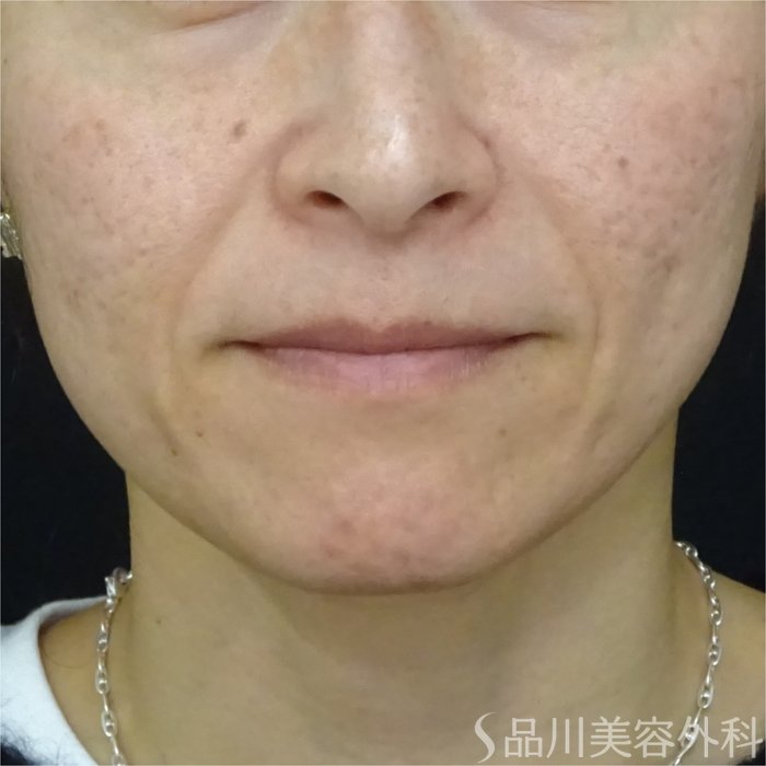 症例NO.69056のBEFORE写真