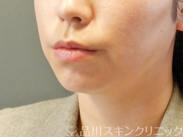 症例NO.63593のBEFORE写真
