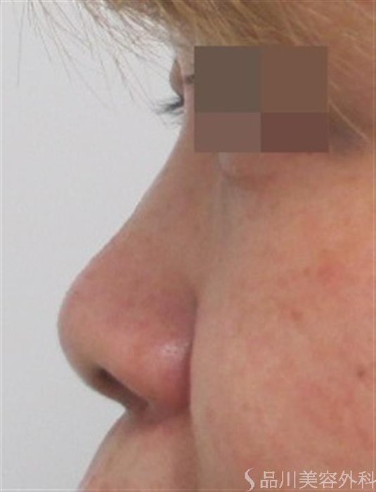症例NO.23857のBEFORE写真