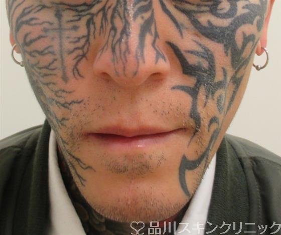 症例NO.26721のAFTER写真