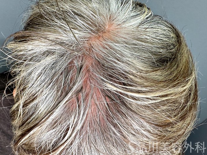 症例NO.73400のBEFORE写真