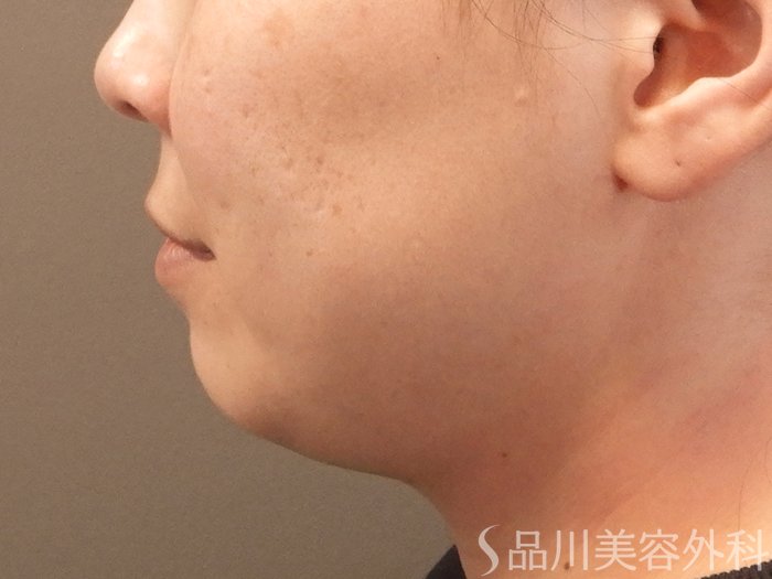 症例NO.69356のBEFORE写真