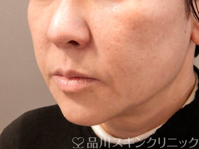 症例NO.69756のBEFORE写真