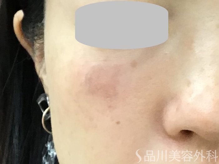 症例NO.67846のAFTER写真