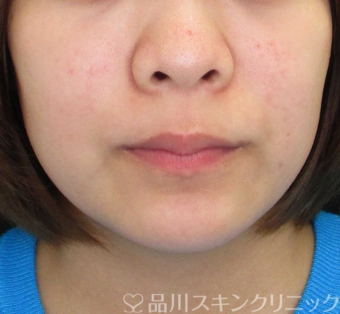 症例NO.65527のBEFORE写真
