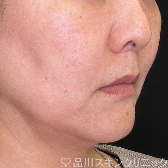 症例NO.74297のBEFORE写真
