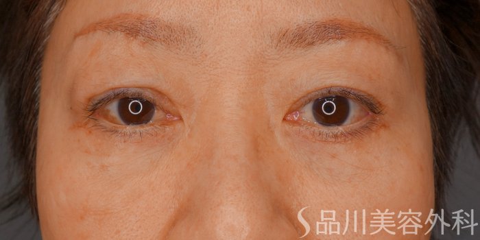 症例NO.73222のAFTER写真